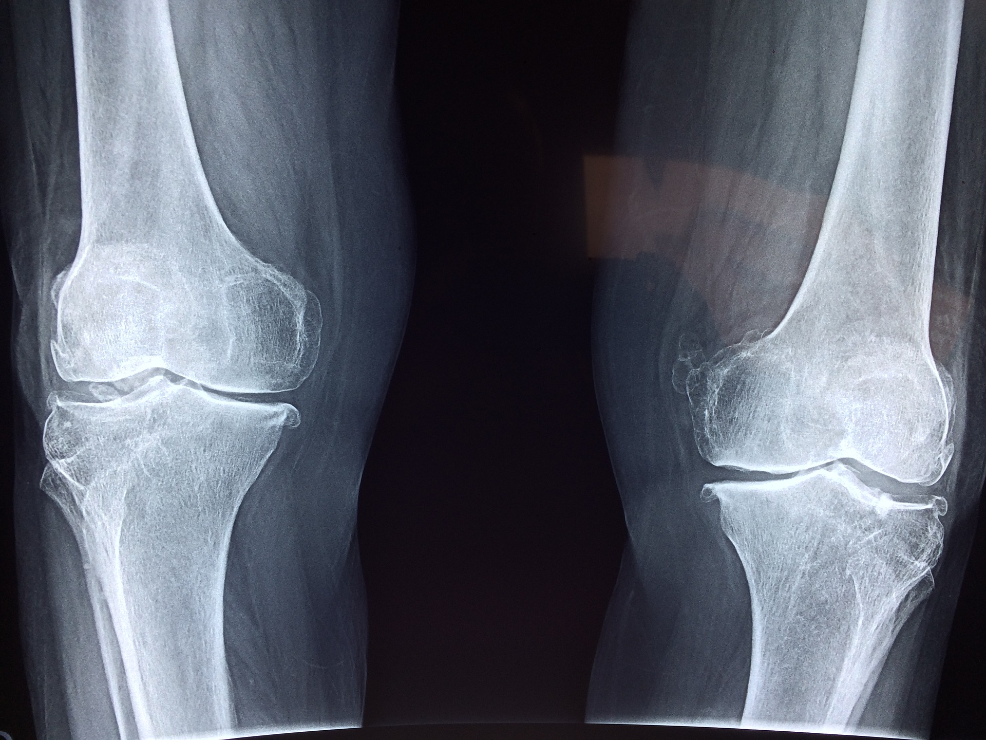 knee2253047_1920.jpg