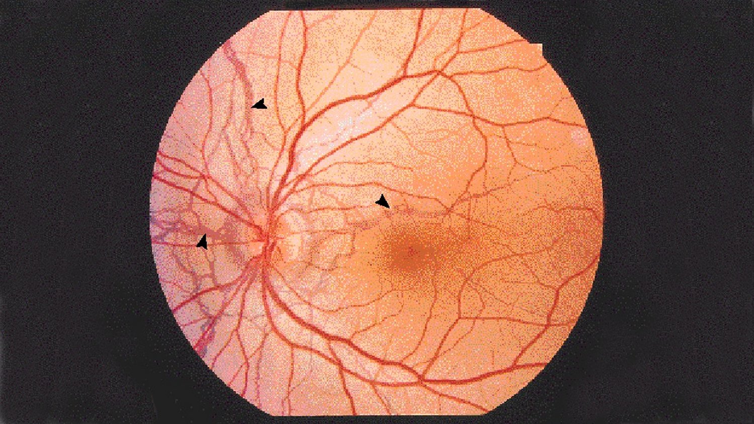 Берлиновское помутнение глаз. Контузия глазного яблока глазное дно. Контузионное помутнение сетчатки. Берлиновское помутнение сетчатки. Берлиновское помутнение сетчатки.